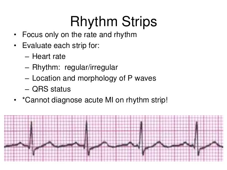 ekg strip of an acute mi Canadian porn movie